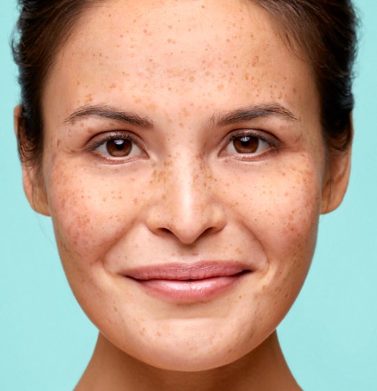 Biodermal Pigmentserum - Pigmentvlekken creme - Vermindert pigmentvlekken - 30ml